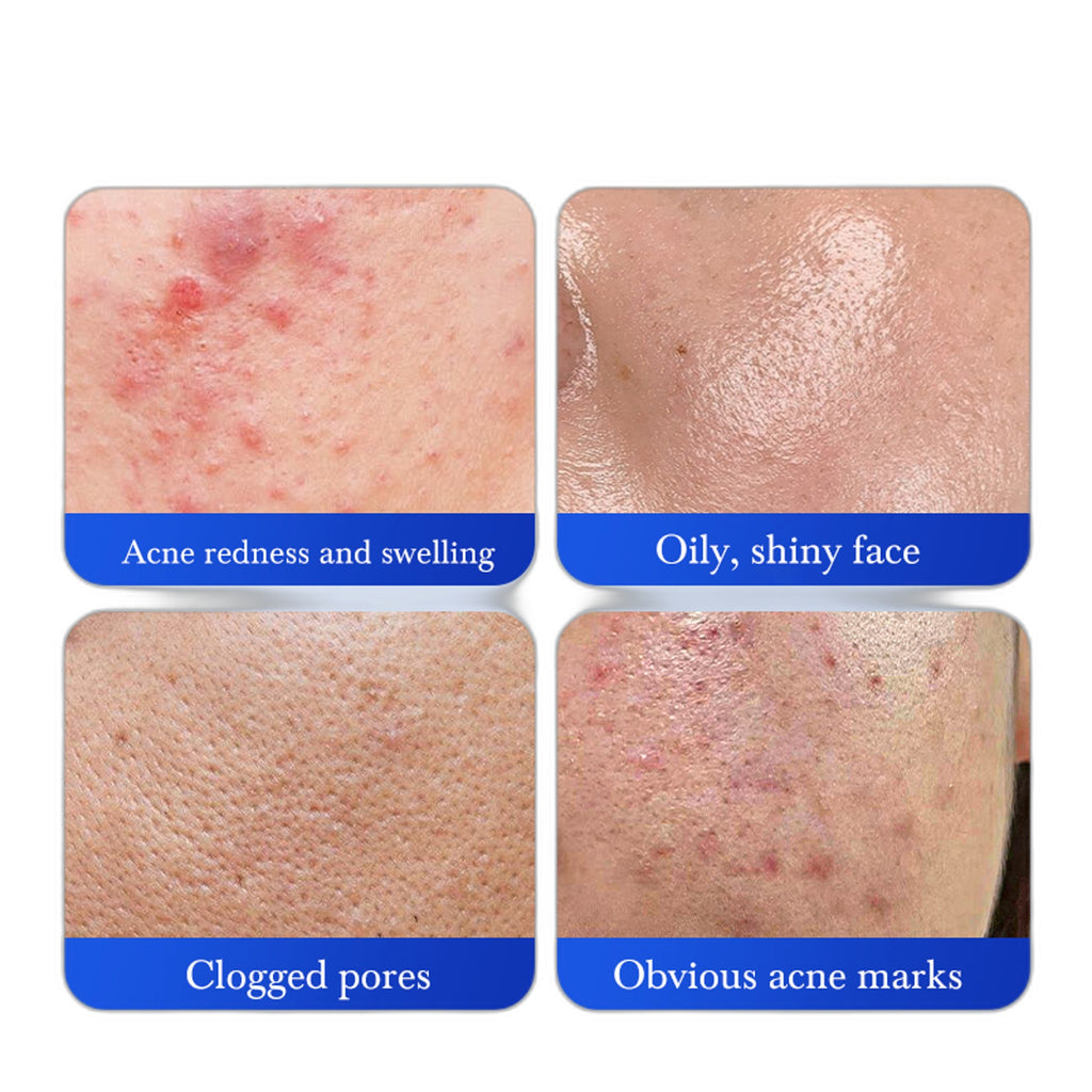 HUNMUI Salicylic Acid Acne-Fighting Facial Cleanser